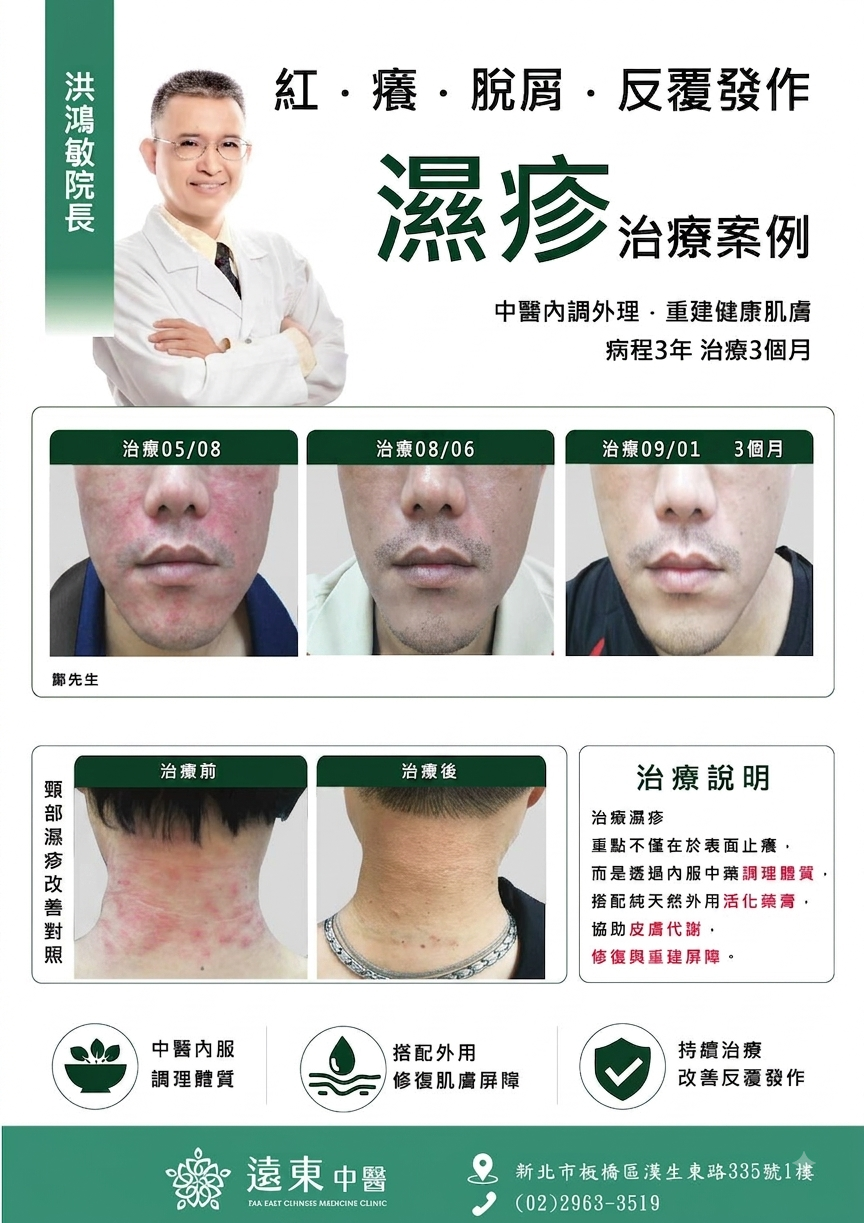 濕疹治療案例
