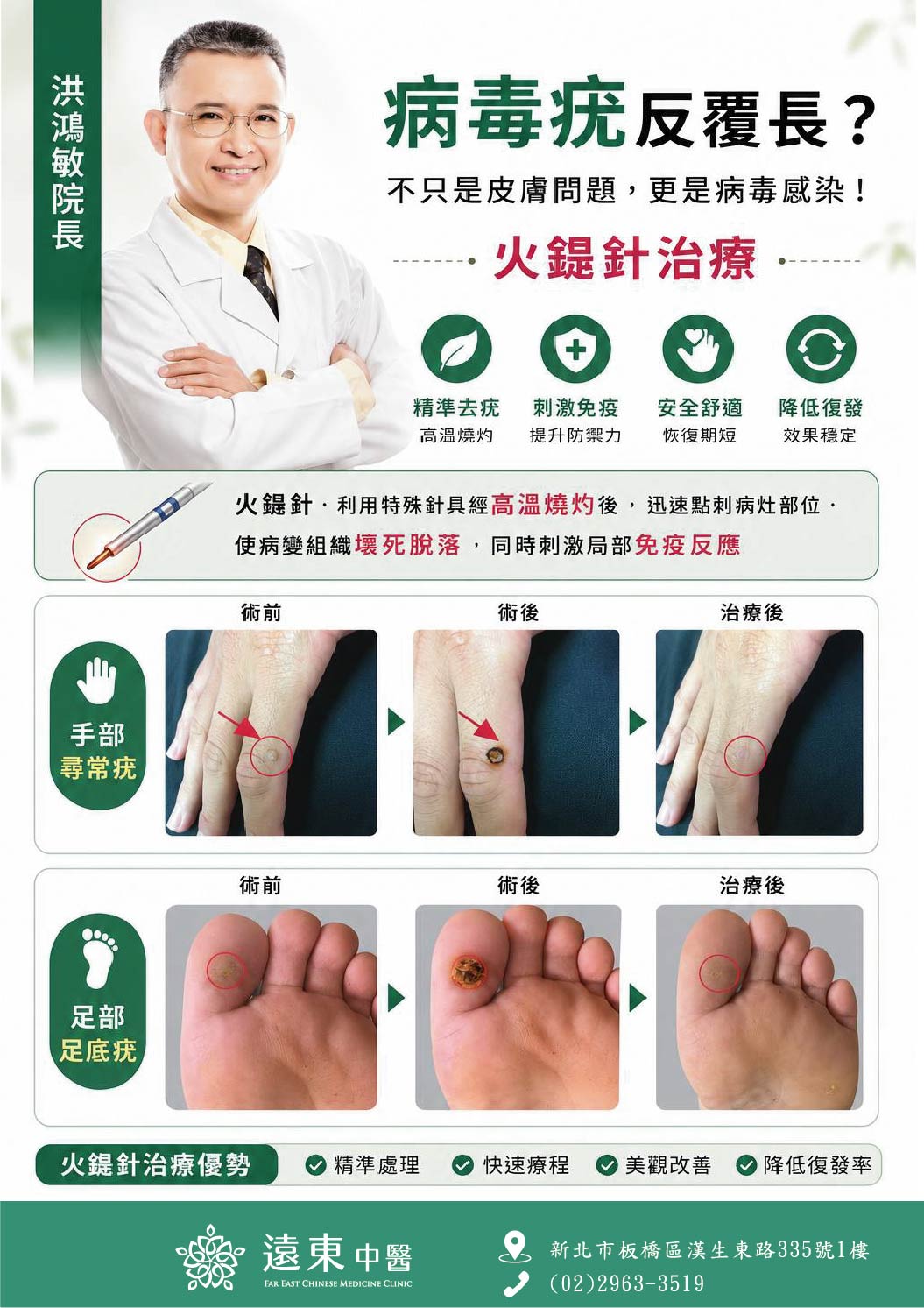 病毒疣治療案例