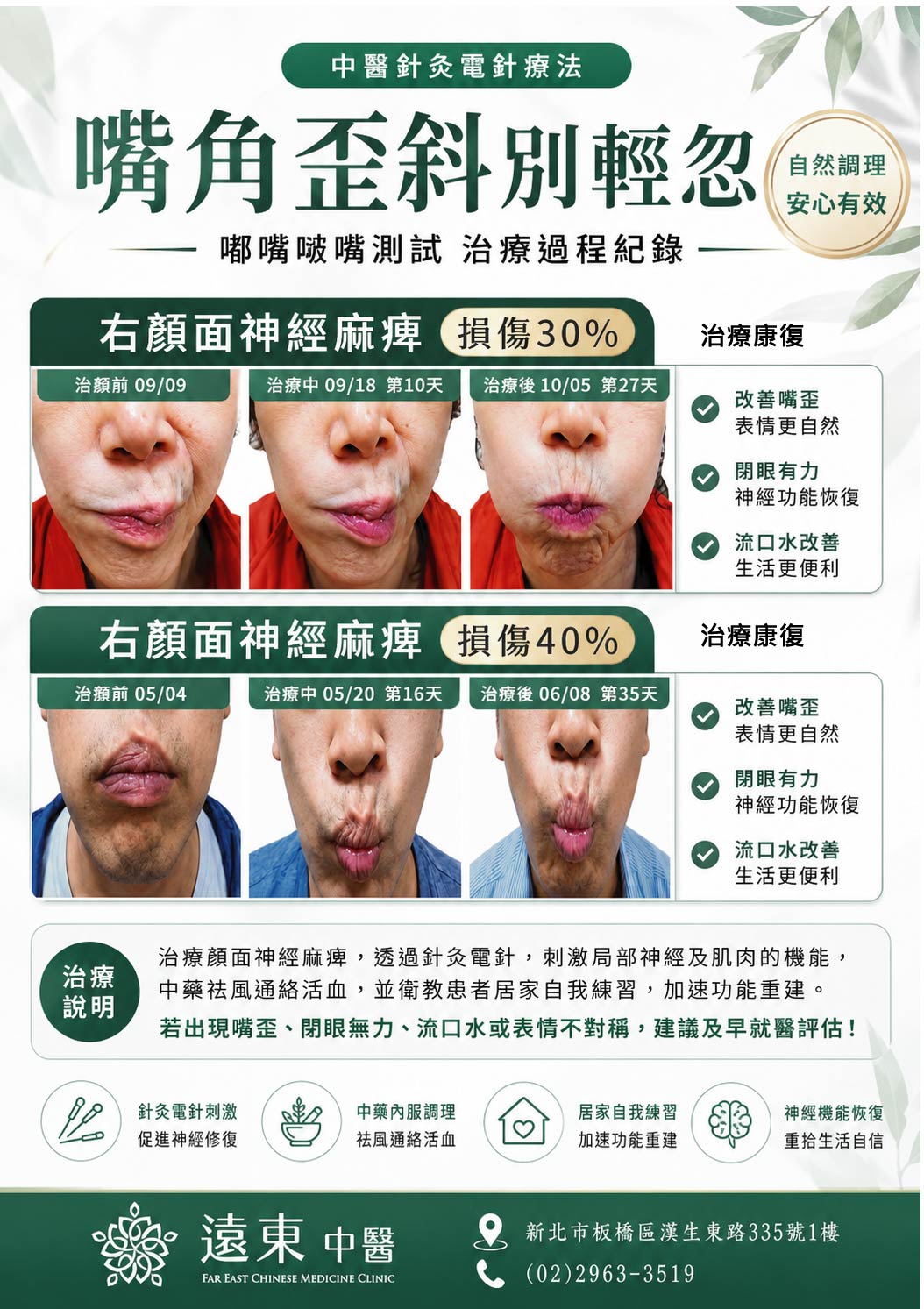 顏面神經治療案例